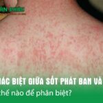 sốt-phát-ban (1)