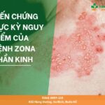 bien chứng cua bệnh zona thần kinh
